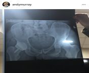 British/Scottish tennis player Andy Murray posted his hip X-ray to Instagram a while back. Little Andy is showing up 😂 from andy rocdick penis cock nude naked